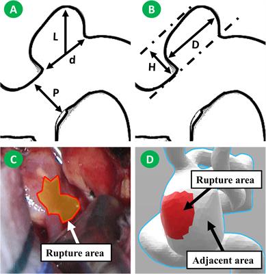 The Morphological and Hemodynamic Characteristics of the Intraoperative Ruptured Aneurysm